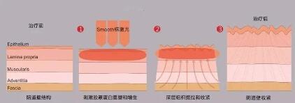 阴道松弛了,尴尬事和闹心事就会接踵而至